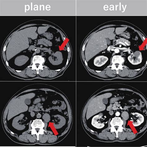 severe global hypokinesis prognosis.